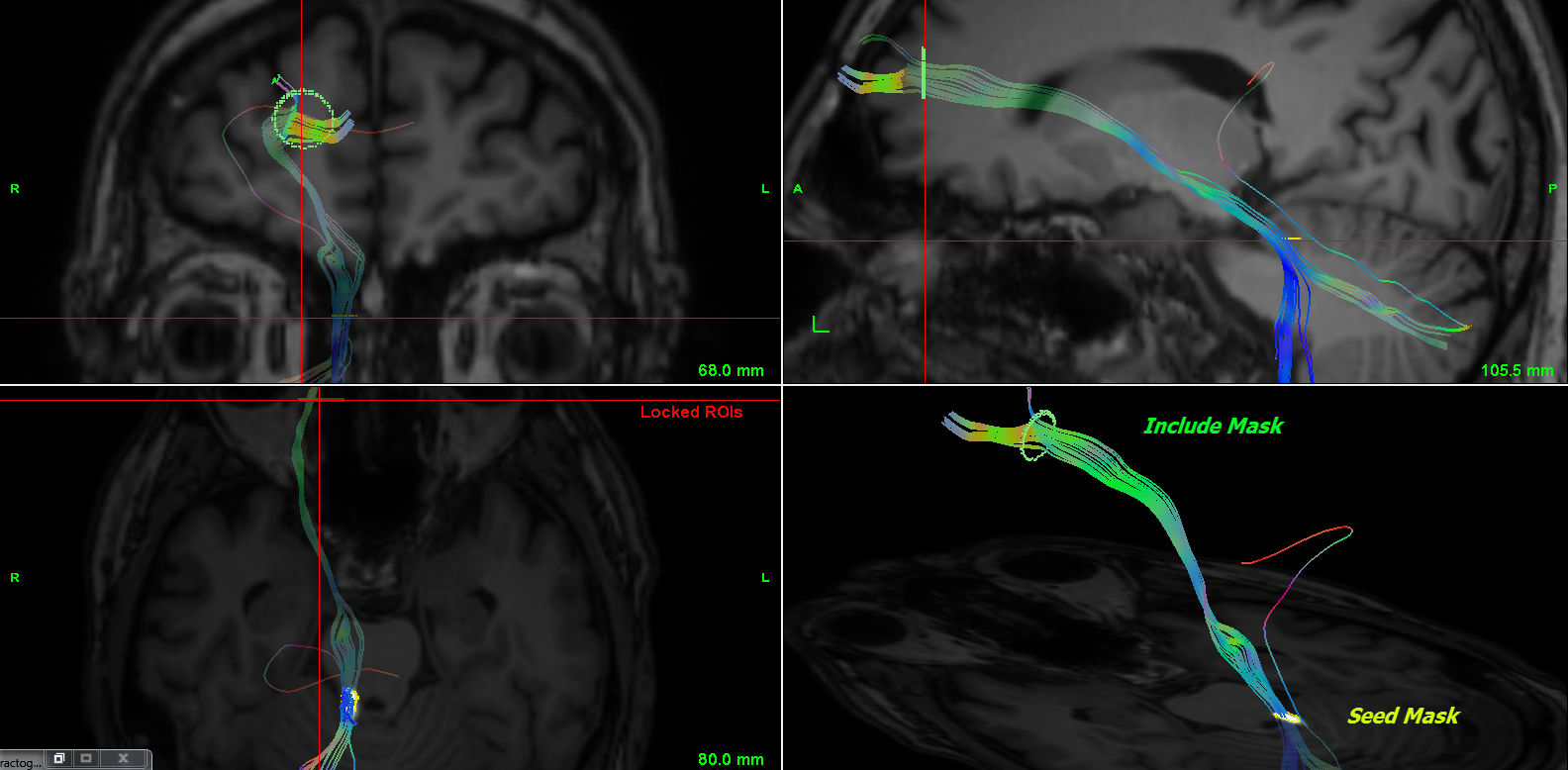 tractography