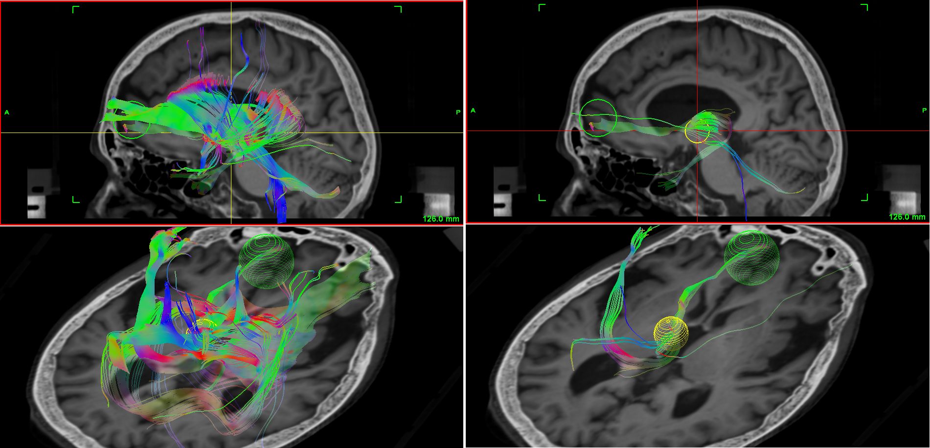 tractography