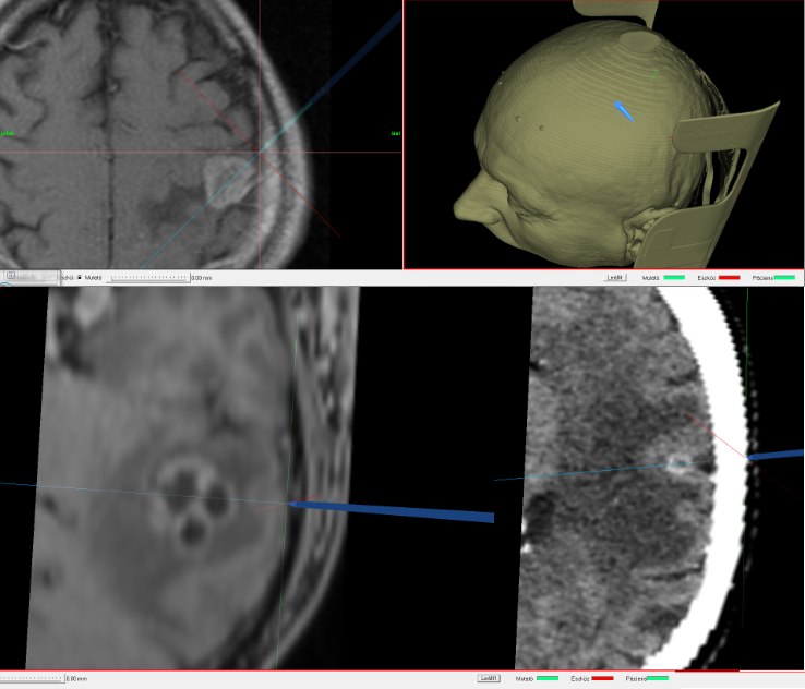 tumor_tracking