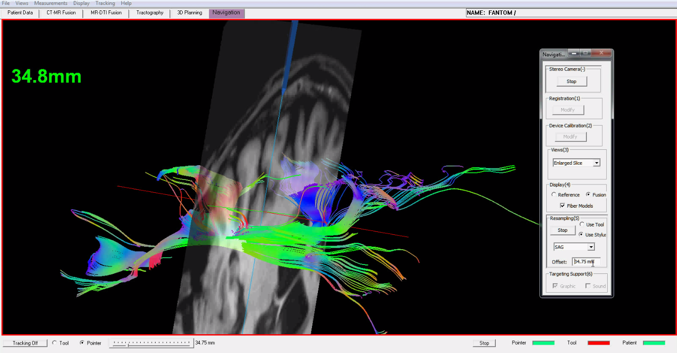 ctmrfusion