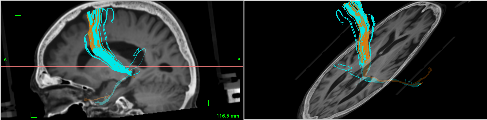 tractography