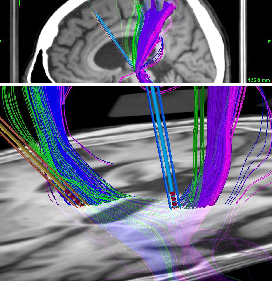 tractography